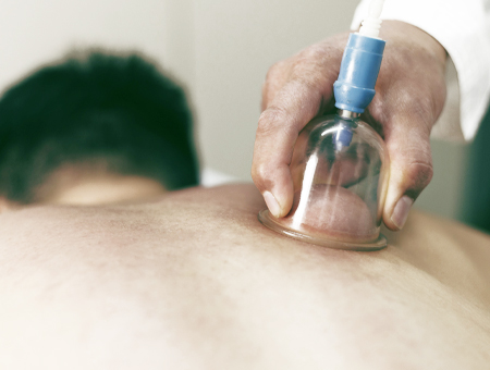 Cupping therapy 2